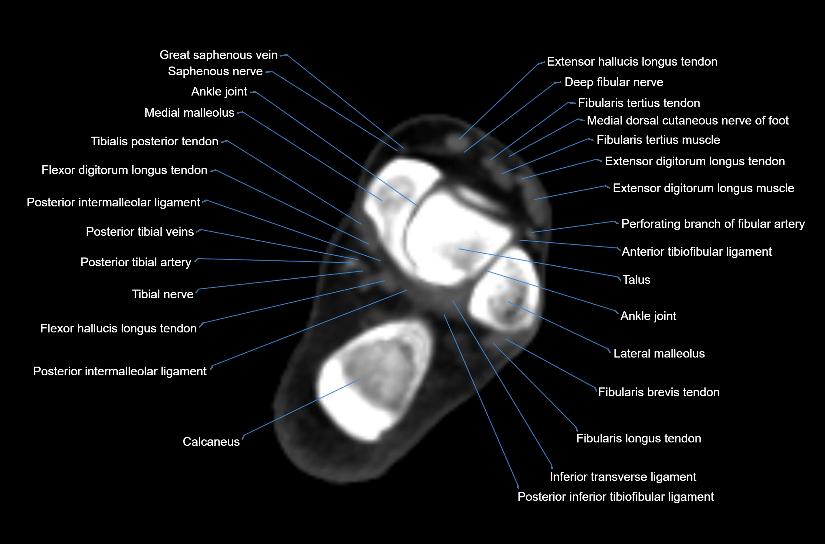 CT Ankle axial cross sectional anatomy labelled image -00030.webp